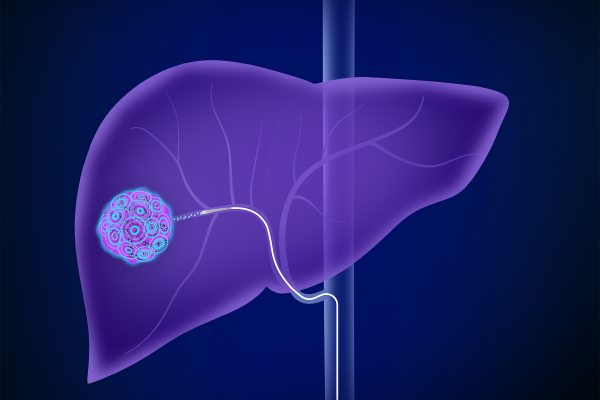 liver cancer image