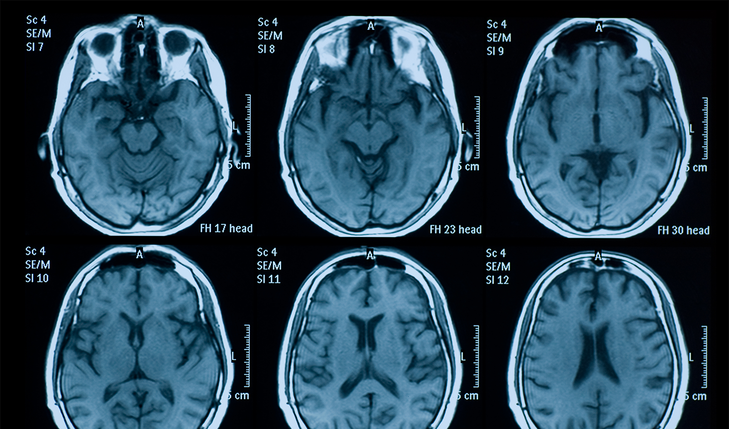 Депрессия головного мозга. Снимки головного мозга. Мрт мозга. Магнитно-резонансная томография головного мозга. Мрт снимки мозга.